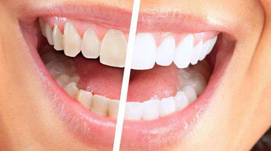 Grupovina | Akcije, Popusti i Kuponi za Lepotu Izbeljivanje zuba laserom! Popusti